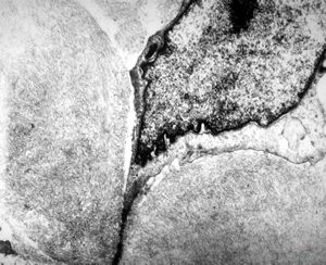 F,79y. | jejunum - amyloidosis F,79y. | jejunum - amyloidosis